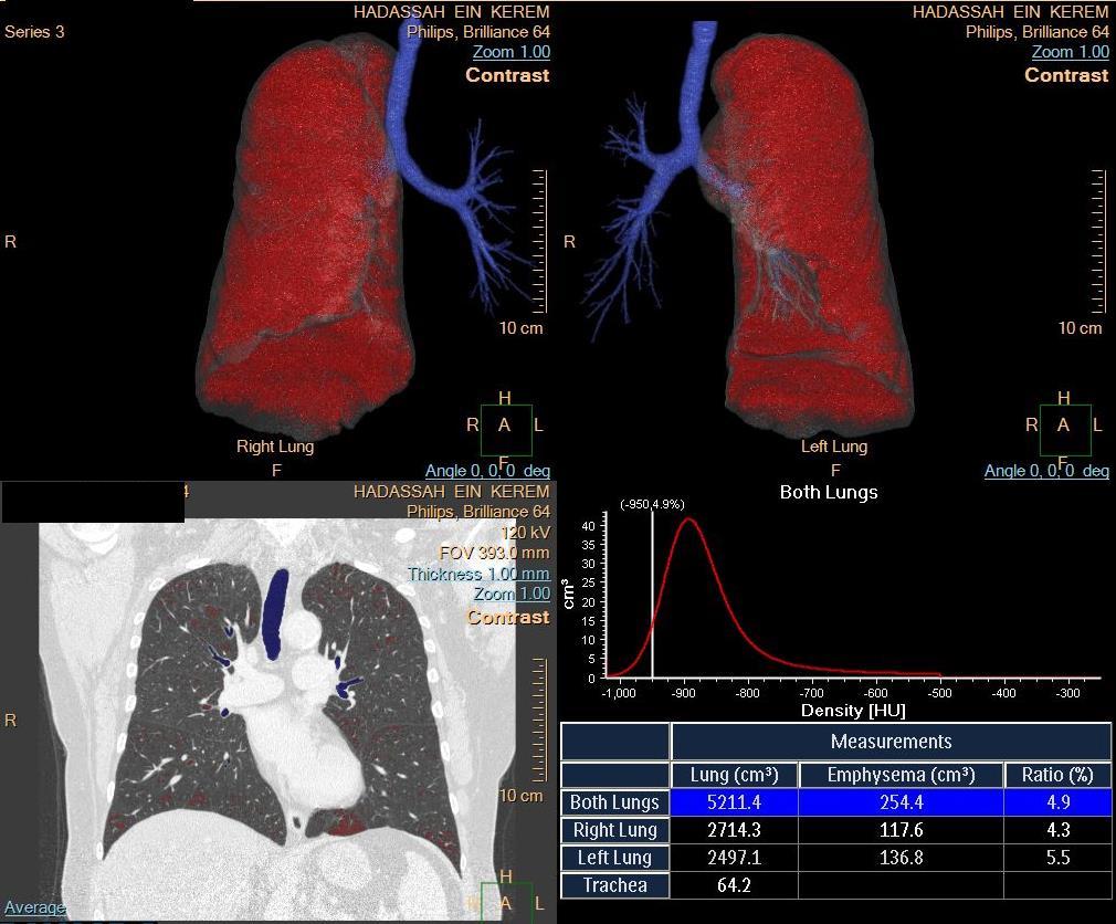 Figure 1 Example of output of lung emphysema protocol analysis of CT scan Top each lung shown separately. Red indicates emphysematous area. Bottom left a coronal slice from the CT scan analyzed.