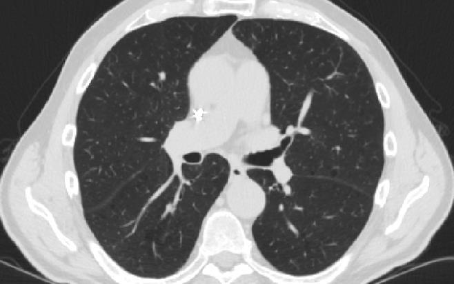 Figure 2 Chest CT of the middle zones