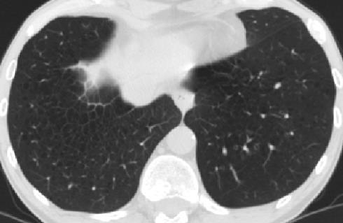 1 Figure 3 Chest CT of the lower zones