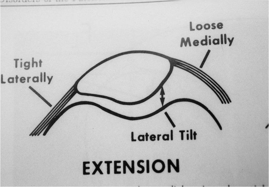 חכו יש עוד Quadriceps Weakness- Has been shown to be an Independent Risk Factor for Knee OA Cartilage Degeneration & Osteoarthritis Excessive Lateral Pressure and Tight Lateral Retinaculum ועוד כמובן.