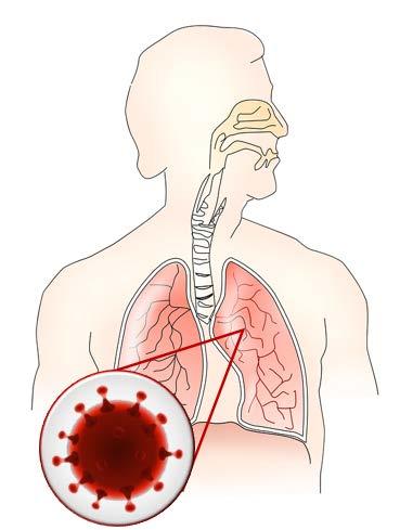תאי PLX כטיפול למקרי COVID-19 קשים המלווים בתסמונת מצוקה נשימתית חריפה (ARDS) זיהום מנגיף הקורונה (SARS-CoV-2) גורם למספר מחלות נשימה קשות הכרוכות בצורך בטיפול נמרץ ושיעור תמותה גבוה.