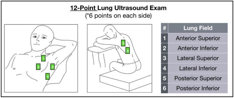 C: Phased array probe [62] מיקום המתמר לפי שיטת 12 הנקודות: ישנן שיטות שונות לביצוע POCUS להסתפק בבדיקת ריאתי. ברוב מחלות הריאה, ניתן 6-8 נקודות בשדות הריאה.
