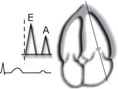 אופן ביצוע בדיקת אקוקרדיוגרפיה תפקודית ביילודים עם לחץ דם נמוך E / A ratio E-wave, representing the early, passive filling of the left ventricle, that happens late in diastole.