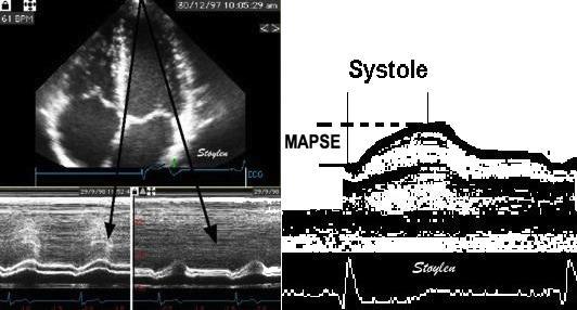 of the base can be displayed as a motion curve, and the peak systolic