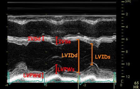 M-mode LV dimensional method: From parasternal long axis view and place a M-mode cursor through the septal and posterior LV walls just beyond the tip of the mitral leaflets.