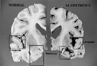 Normal Alzheimer