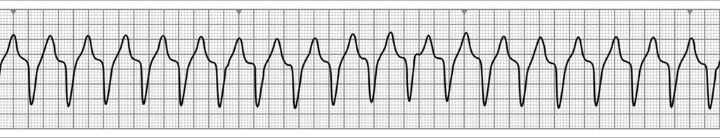 66. החולה מחובר לניטור קרדיאלי ובמסך מופיע תרשים המצביע על: Ventricular Fibrillation Ventricular Tachycardia Ventricular TachycardiaSupra Complete AV Block א. ב. ג. ד. 67.