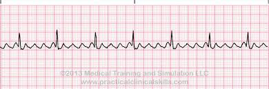 19. תרשים א.ק.ג הבא אופייני לאיזה סוג של הפרעת קצב הלב : Ventricular Tachycardia Atrial Flutter Complete Av Block Acute MI א. ב. ג. ד. 20. במחלקה נמצא חולה לאחר צנתור.