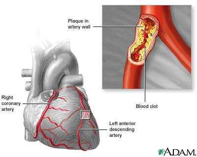 טרשת עורקים Atherosclerosis = Athero עורק = Sclerosis התקשות התעבות ואיבוד הגמישות של