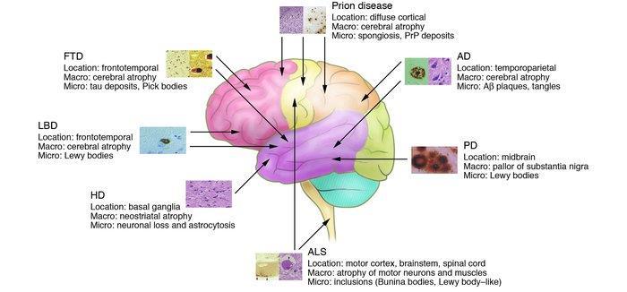 Creutzfeldt-Jakob Disease (CJD) Rapid cognitive degeneration Frontotemporal Dementia (Pick s Disease Dementia