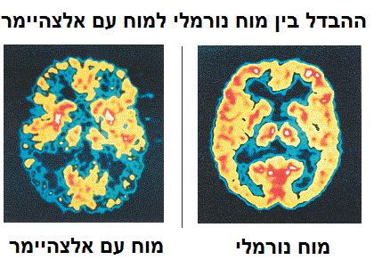אלצהיימר מחלת אלצהיימר מהווה הגורם העיקרי לדמנציה.