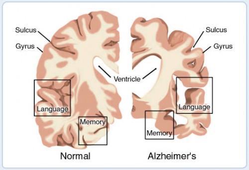 Alois Alzheimer המחלה זוהתה בחולה בן 51 שסבל מאובדן זכרון ונפטר לאחר 5 שנים.