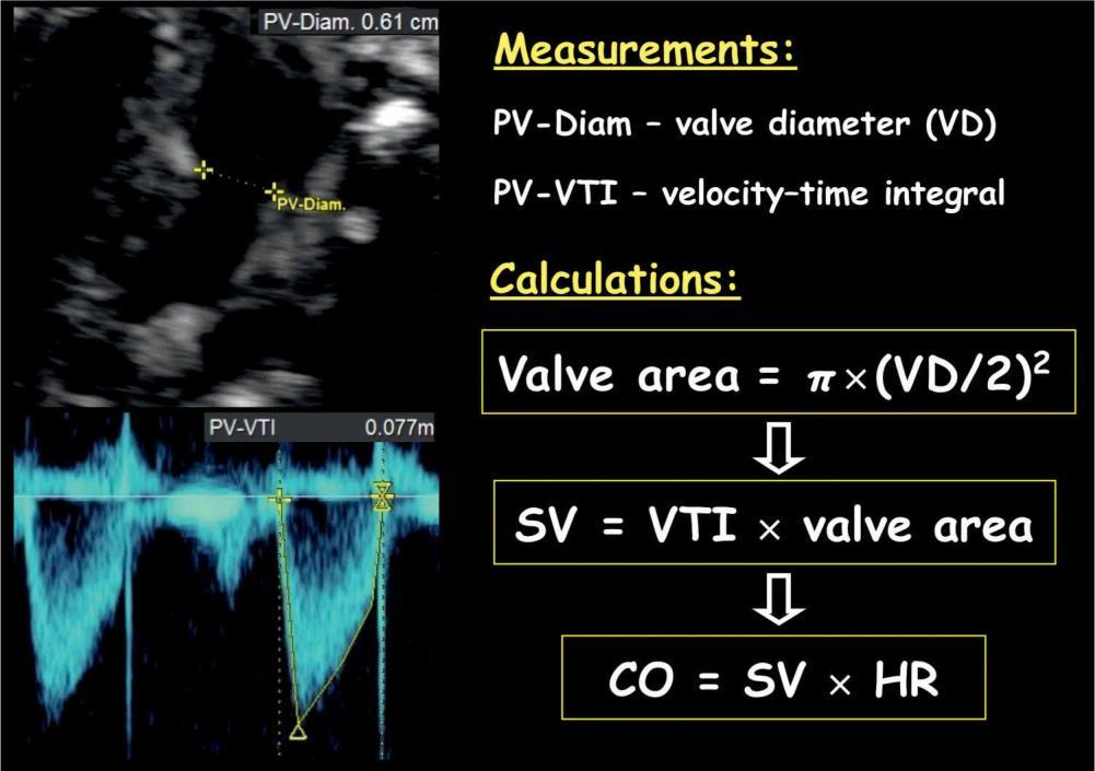 Pulmonary Valve Velocity Time Integral From the PLAX view - angle to pulmonary artery view, Pulse Doppler VTI, and Annular diameter measurement.