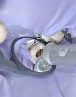 DENTAL TRIBUNE ISRAEL 08/2020 2 טכנולגיית הלייזר במרפאות שיניים המשך מעמוד 1 תקין, טיפול שורש בוצע לאורך תעלות השורש. תהליך רדיולוצנטי נרחב סביב חודי השורשים )תמונה 4 צילום רנטגן אבחנתי(.