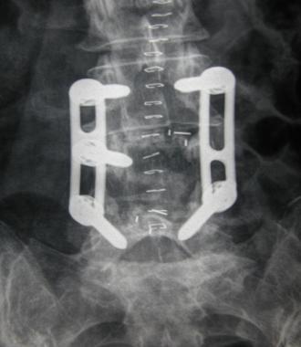.2 קיבוע מתכתי של עמוד השדרה מותני וצווארי fusion).(spinal בניתוח זה, מבצעים איחוי בגישה אחורית או קדמית של החוליות בעזרת ברגים מתכתיים.