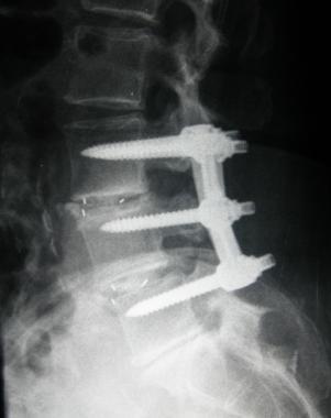 ניתוח זה מבוצע במקרים של הצרות תעלת השדרה, כאשר התפתחה אי יציבות נרכשת של עמוד השדרה עקב שינויים ניווניים או כתוצאה מניתוחים חוזרים. וכן במצבים של ספונדילוליזיס וספונדילוליסטזיס.