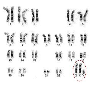 גילוי שכרומוזום X נוסף לא קובע את מין העובר [ [קריוטיפ