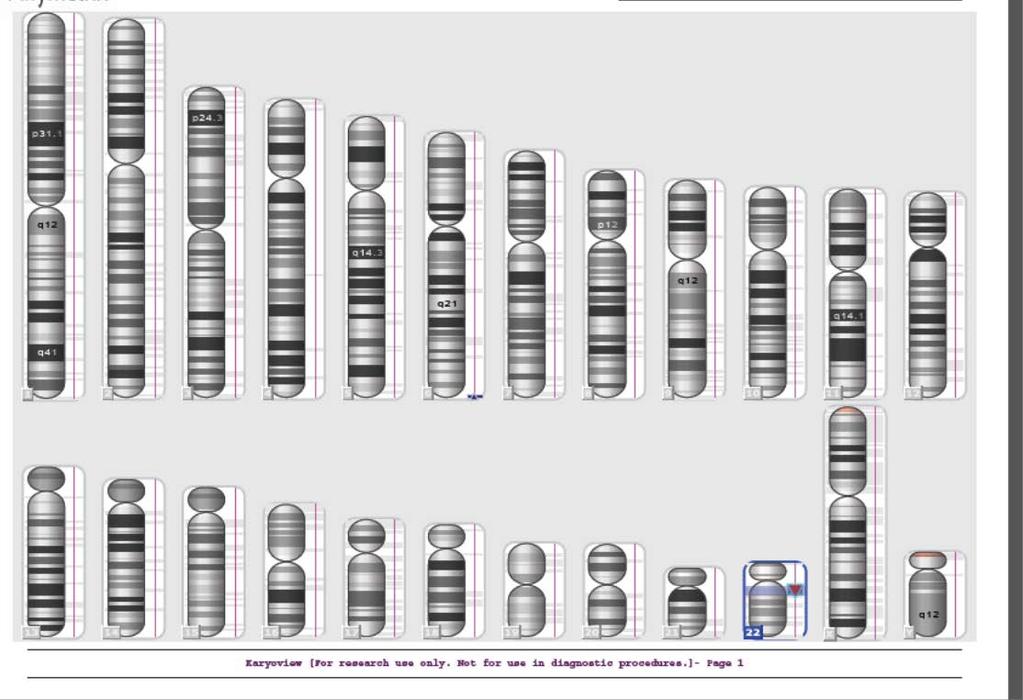 בדיקת סקירה באמצעות הצ'יפ מסוג -CGH מקרה 2 ממצא של חסר בכרומוזום 22 בנוסף: בכרומוזום 6 תוספת שקיימת רק אצל מקרה 2 (מכיל את הגנים הבאים: (FMF120B, TBP,