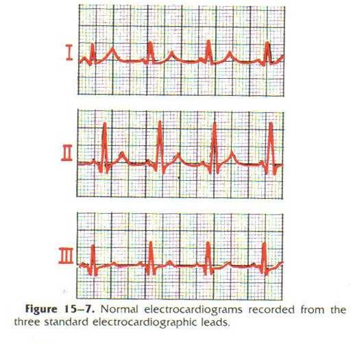 צורת EKG בא ד ם