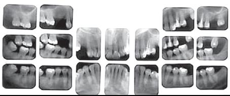 18 צילום נשך בצילום זה מקבלים תמונה של כותרות השיניים העליונות והתחתונות באחד מצידי הפה. הצילום מיועד לגילוי עששת בין השיניים )במקומות המגע שבין השיניים(.