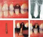 34 פרק 4 טיפולי שיניים פרוטטיים )שיקום הפה( ענף ברפואת השיניים העוסק בשיקום ושיחזור הפה כפועל יוצא ממפגעים שגרמו לעקירת שיניים או הצורך בשיקום שן בודדת לאחר טיפול שורש.