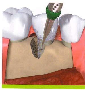 החומר מוחדר לאזור שבו נספגה העצם מסביב לשיניים במהלך ניתוח חניכיים פשוט, וגורם לבניה מחודשת של העצם שנספגה.