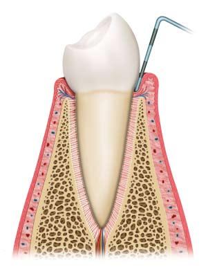 5 שלבים בהתפתחות המחלה במצב בריא אנו יכולים לראות כי השן יושבת בתוך העצם של הלסת. בינה לבין הלסת קיימים סיבים המשמשים כבולמי זעזועים. סיבים אלו נקראים.PDL מבחוץ, החניכיים עוטפים את העצם ואת שולי השן.