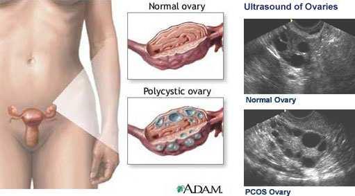 שחלות ריבוי ציסטיות Polycystic Ovary