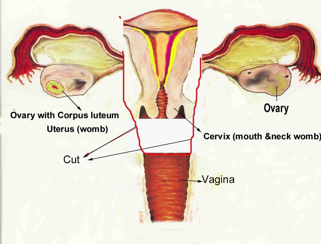 Hysterectomy = צוואר