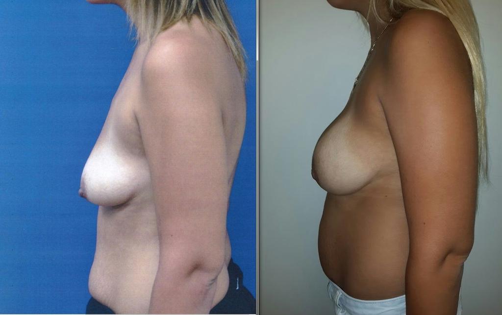 תמונה מס' 2 התובעת ב 24 באוגוסט 2015 ולפני הניתוח. השד מלא יותר אבל גם הכרס השתנתה באופן בולט לעין המשפיע על האסתטיקה הכללית של פרופיל הגוף.