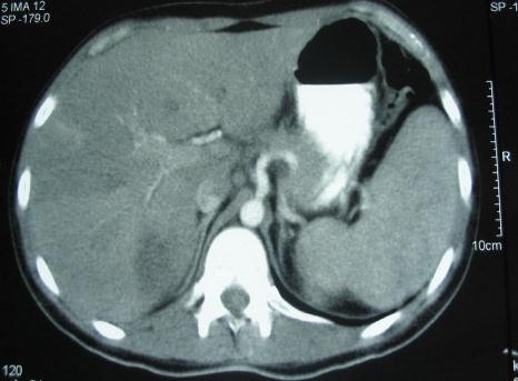 Diagnosis Abdomino-pelvic contrast-enhanced CT -